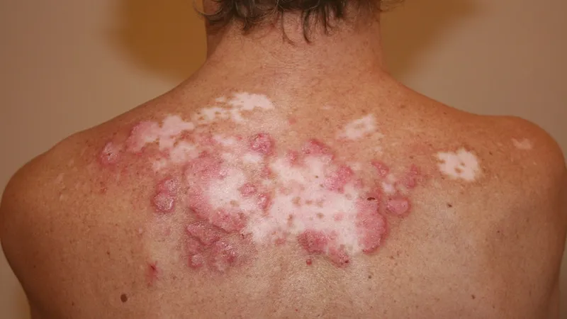 Virus Corona Epstein–Barr (EBV)