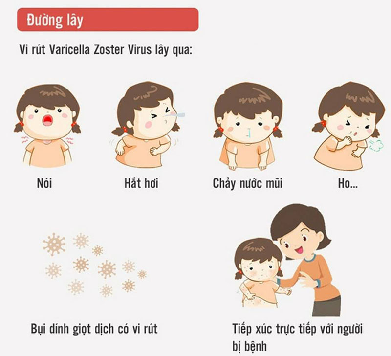Nguyên Nhân Lây Nhiễm Thủy Đậu