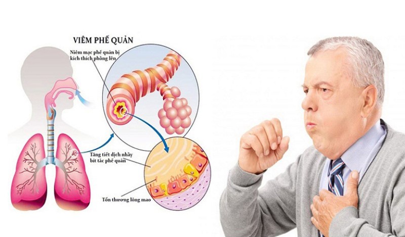 Triệu Chứng Viêm Phế Quản