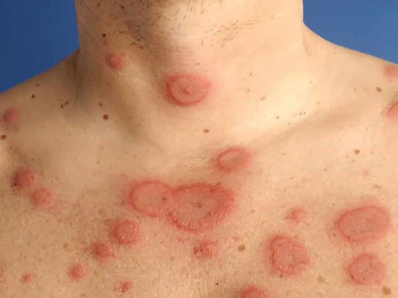 Bệnh Lupus Bản Đỏ Là Gì?