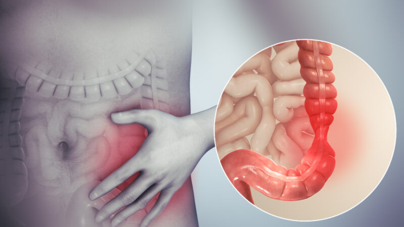 Hội Chứng Ruột Kích Thích Là Gì?