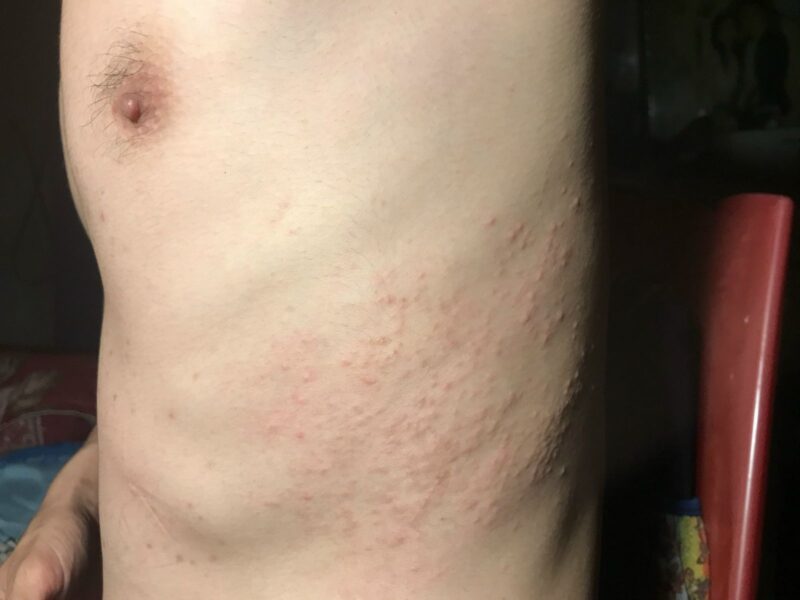 Triệu chứng sán chó ở người