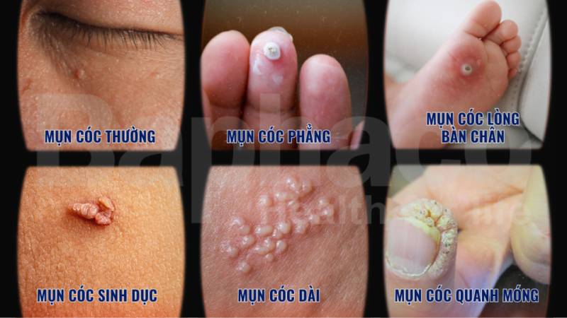 Các Loại Mụn Thường Gặp
