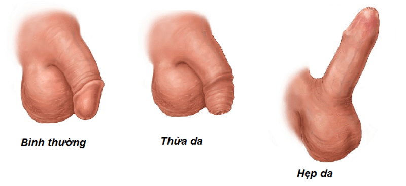 Bao Quy Đầu Là Gì?