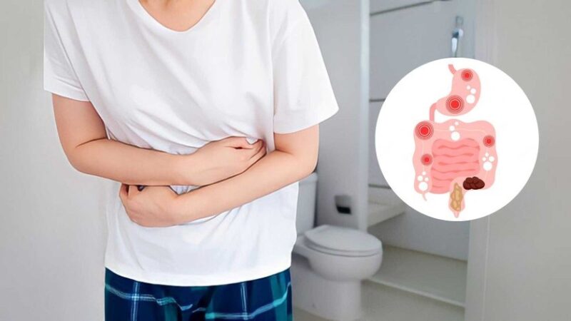 Triệu Chứng Hội Chứng Ruột Kích Thích