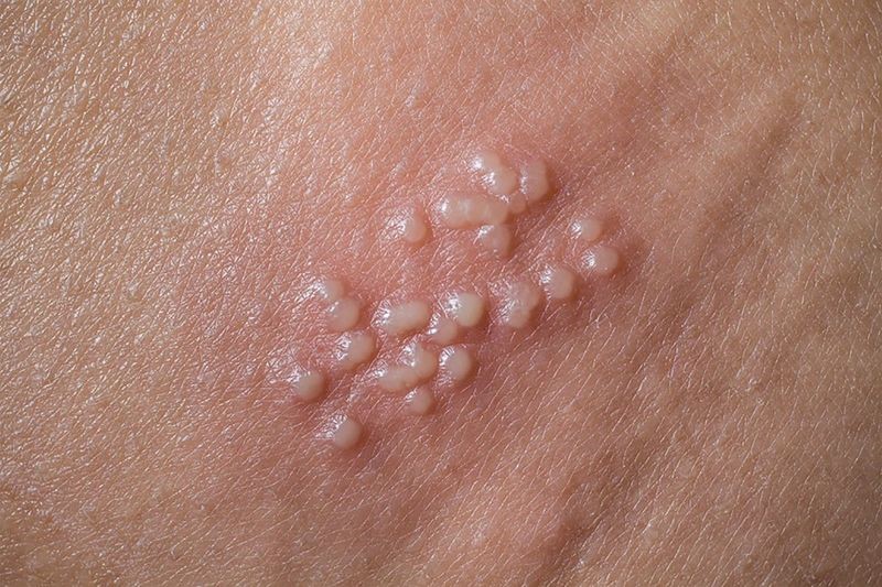 Sùi Mào Gà Là Gì?