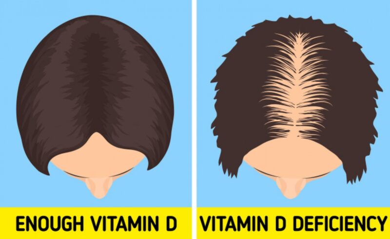 Dấu hiệu Thiếu Vitamin D