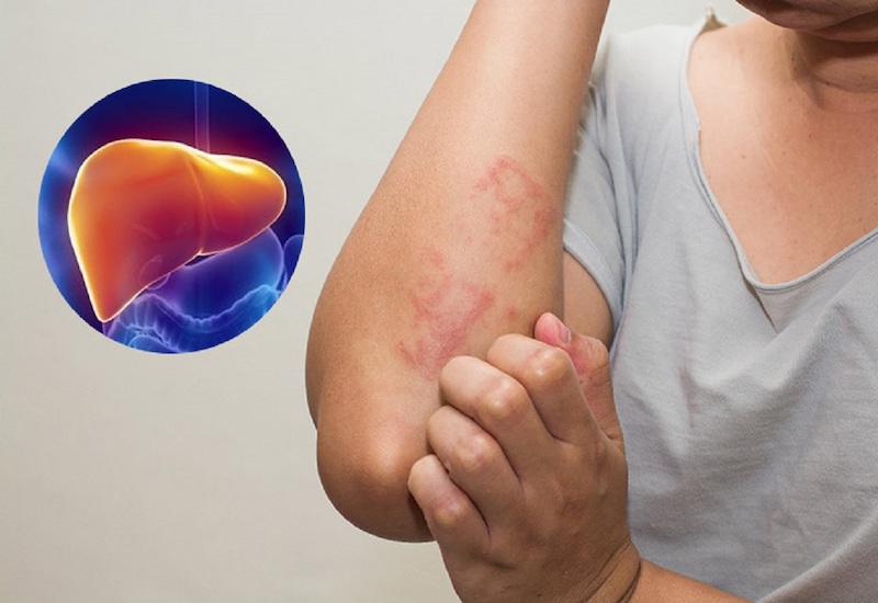 chứng bệnh viêm gan B