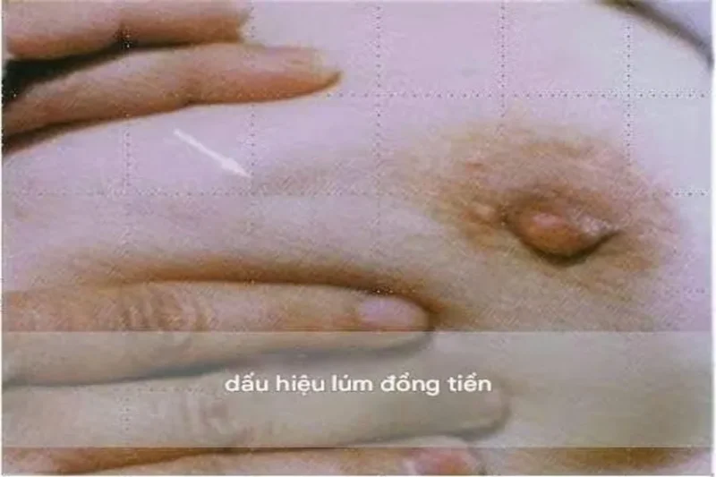ung thư vú là gì và vì sao cần phát hiện sớm
