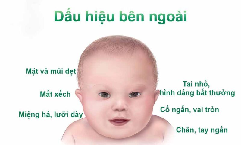 Nguyên nhân gây bệnh Down