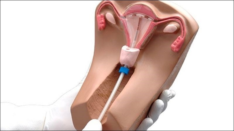 Quy trình thiết lập vòng tránh thai