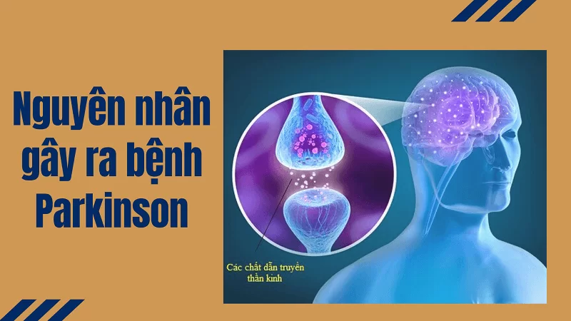 nguyên nhân gây bệnh parkinson