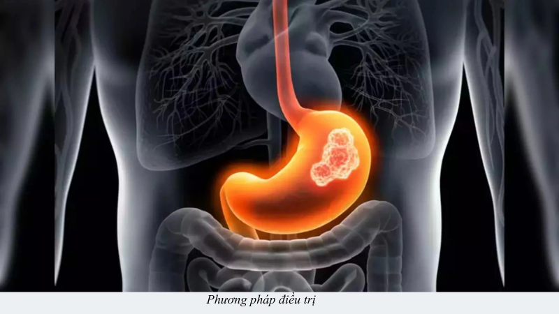 đau dạ dày