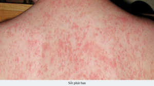 sốt phát ban