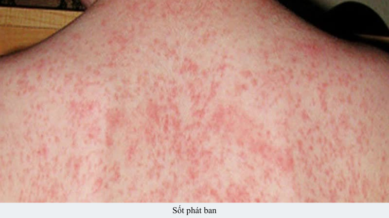 sốt phát ban