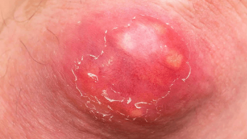 Nguyên nhân gây áp xe