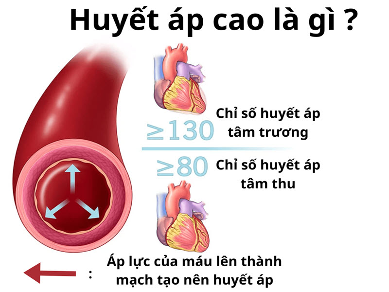 huyết áp cao là gì