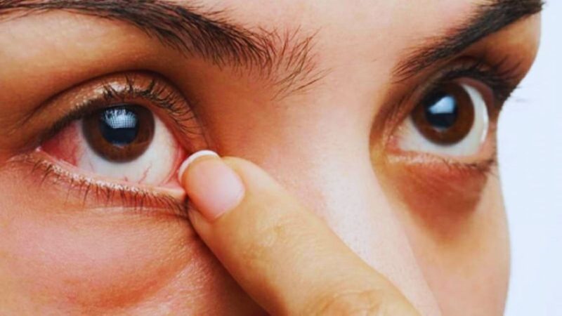 Dấu hiệu nhận biết bệnh giác mạc