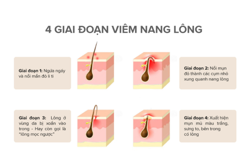 Nguyên nhân gây viêm nang lông