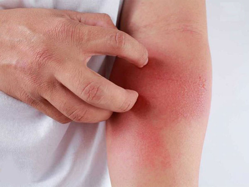 dấu hiệu nhận biết bệnh zona thần kinh