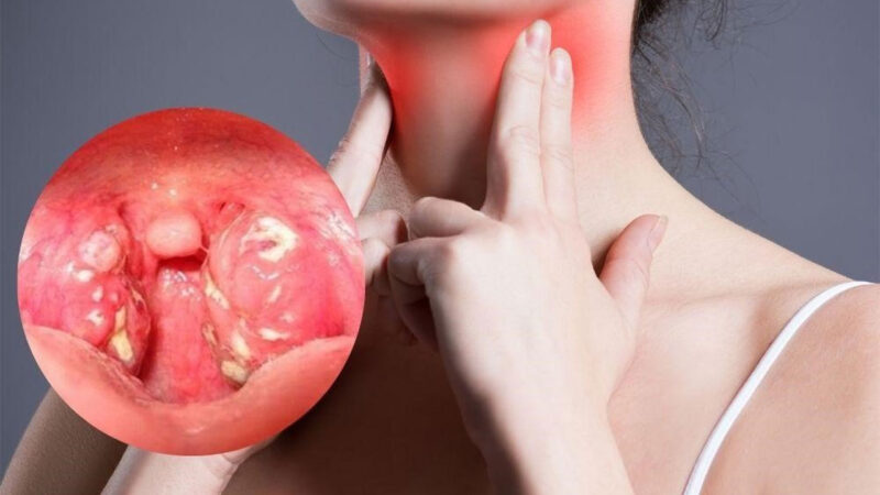 Nguyên Nhân Gay Viêm Amidan