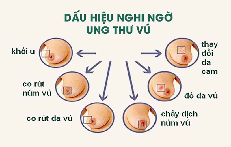 các dấu hiệu ung thư vú thường gặp