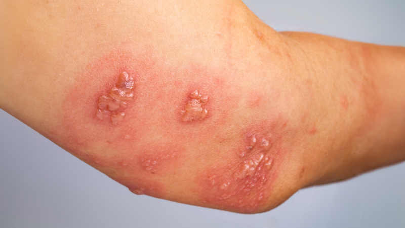 nguyên nhân gây ra giờ sư tử