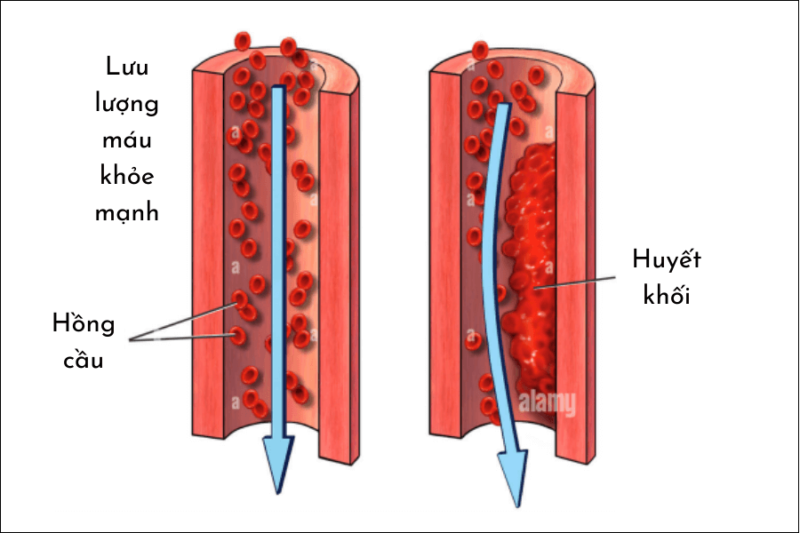 Cơ chế hoạt động của Nattokinase