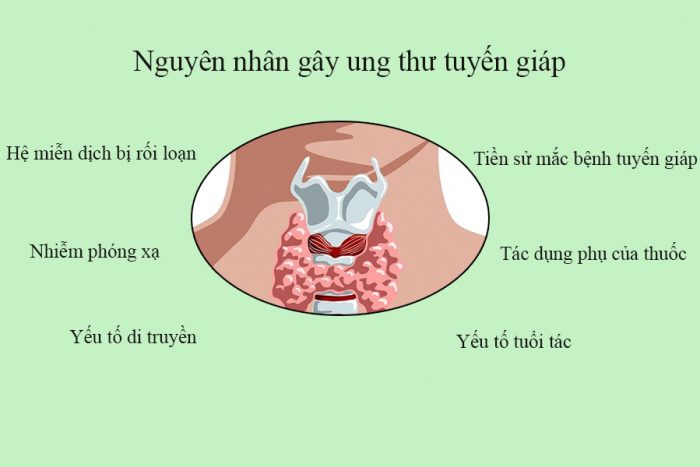 Nguyên nhân gây ung thư tuyến giáp