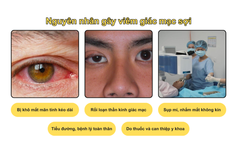 Nguyên nhân gây viêm giác mạc