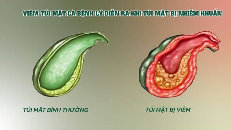 Nguyên Nhân Gay Polyp Túi Mật