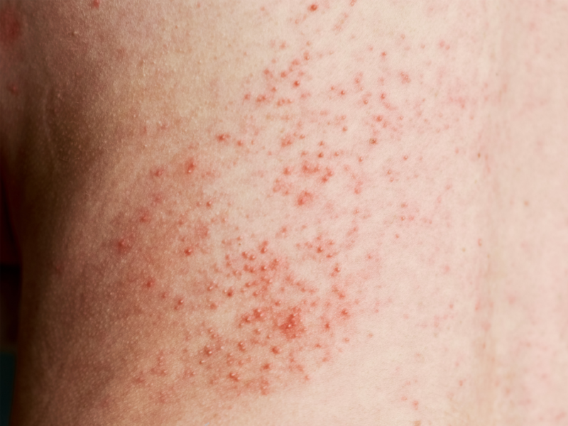 Dấu hiệu nhận biết sốt phát ban