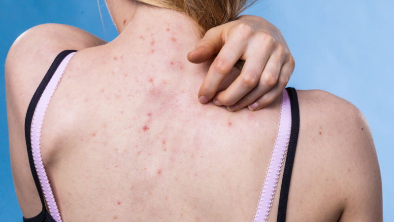 Dấu hiệu nhận biết bệnh viêm nang lông