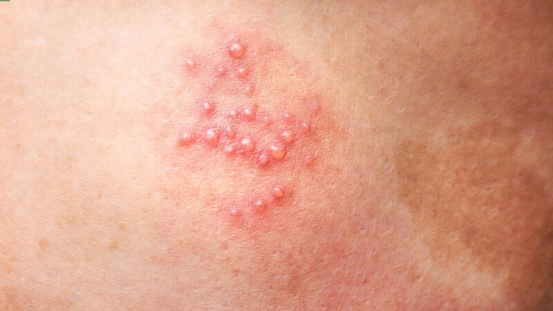 bệnh zona thần kinh là gì