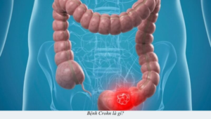 bệnh crohn