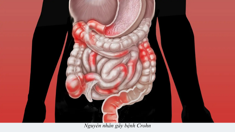bệnh crohn