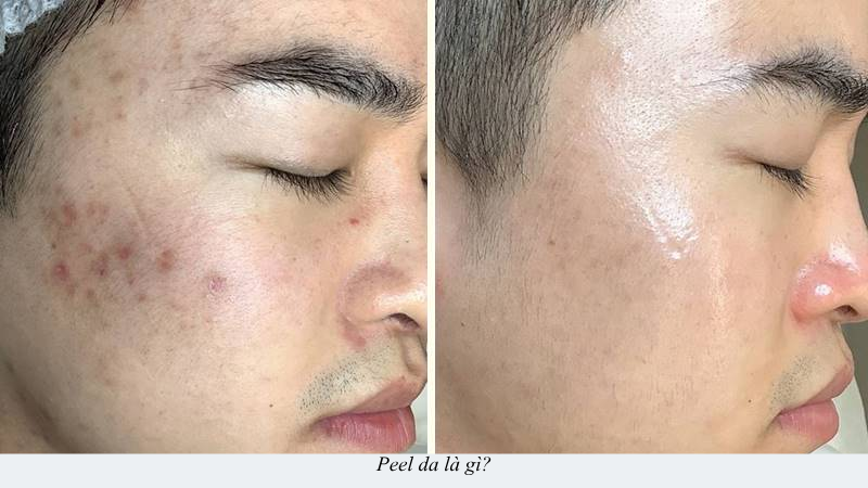 peel da là gì