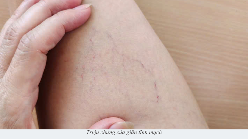 giãn tĩnh mạch