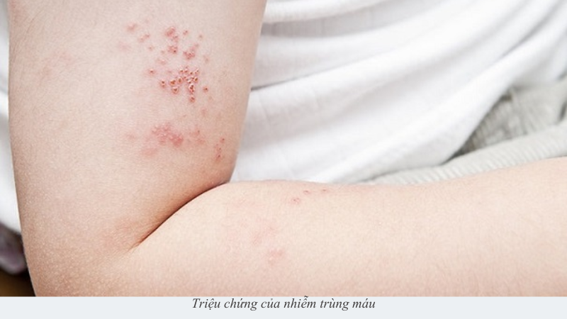 nhiễm trùng máu