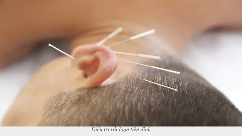 rối loạn tiền đình
