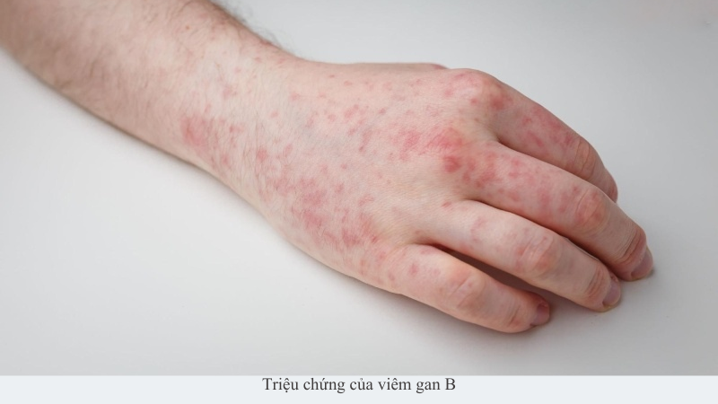 Viêm gan B