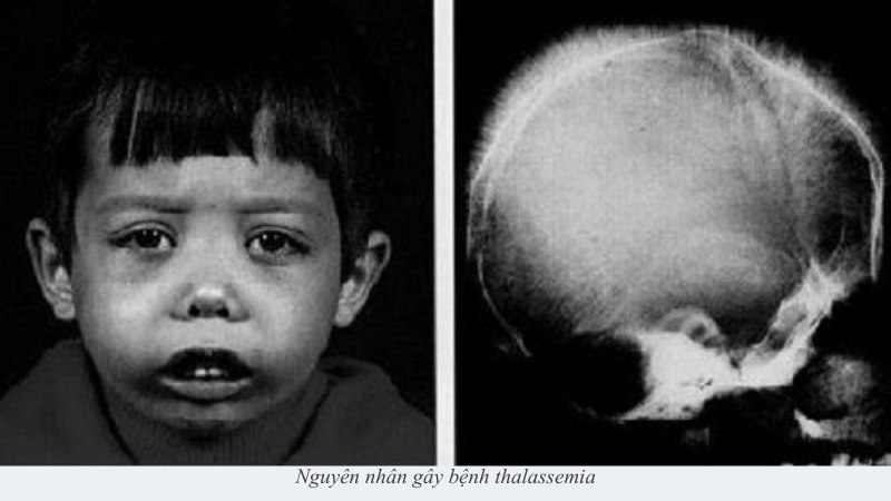 bệnh thalassemia