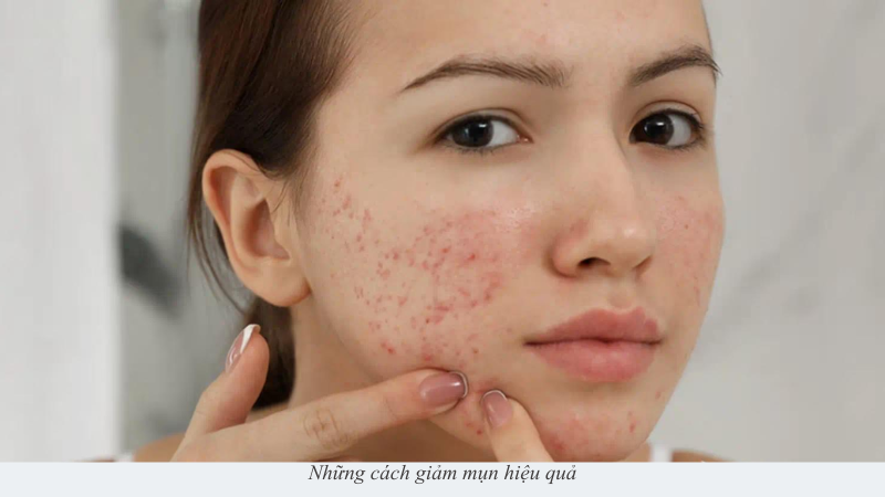 cách giảm mụn