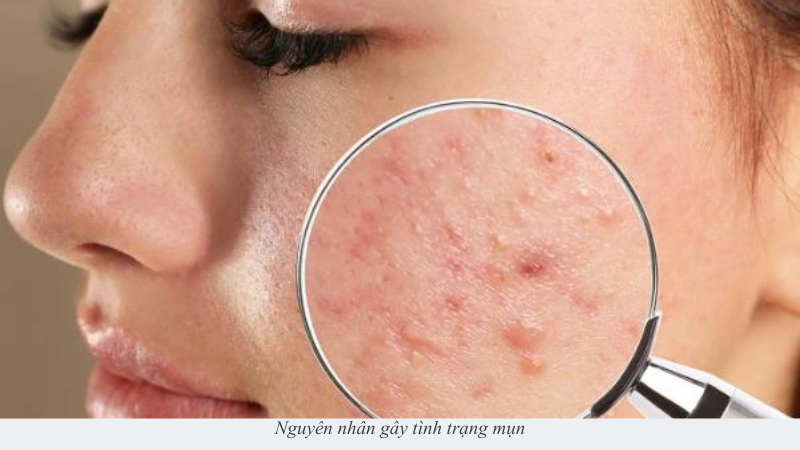 cách giảm mụn