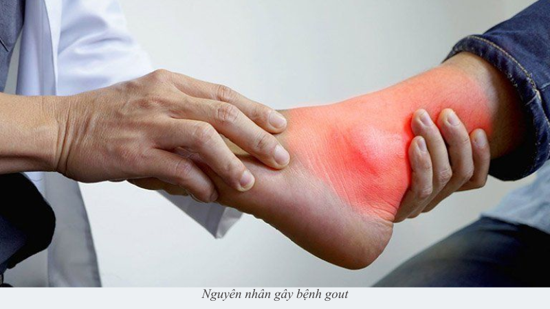bệnh gout
