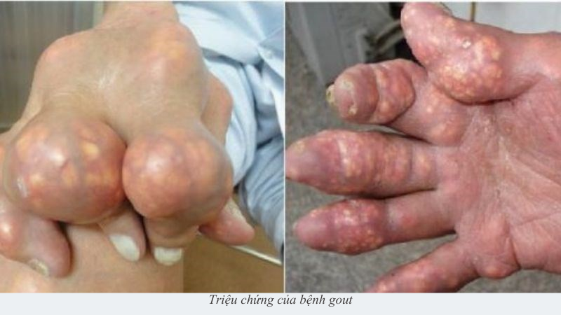 bệnh gout