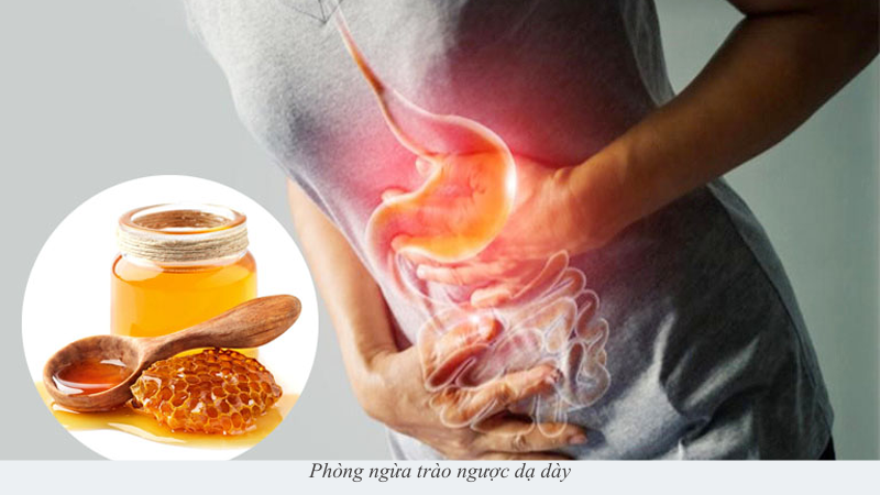 trào ngược dạ dày