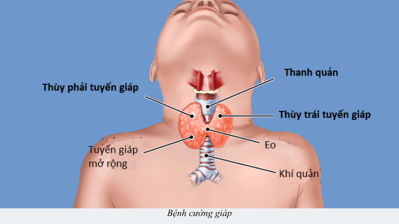 bệnh cường giáp