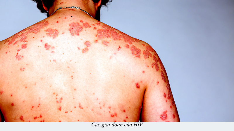 dấu hiệu HIV