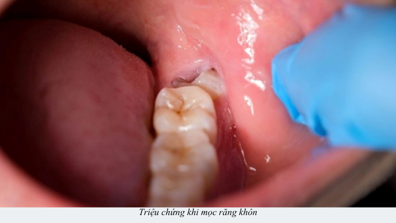 mọc răng khôn